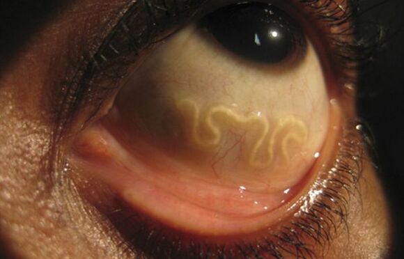 Loa Loa crv živi u ljudskom oku i uzrokuje sljepoću